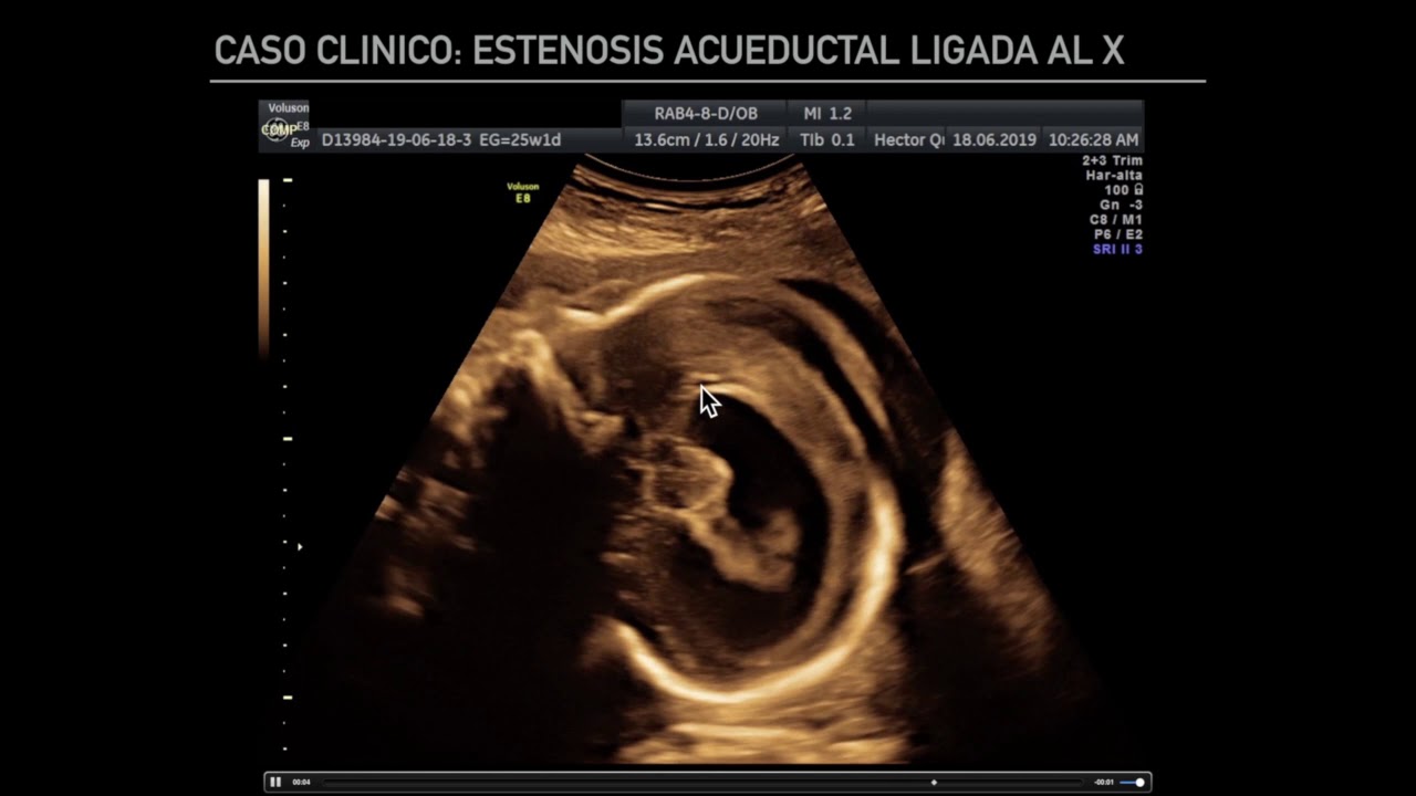 Ventriculomegalia ligada al Cromosoma X + asesoría genética