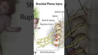 Erb’s Palsy - What’s all about. joenacademy joenwrites josephnwachi medicalvideo mbbs