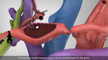 Hepatic artery aneurysm resection and reconstruction