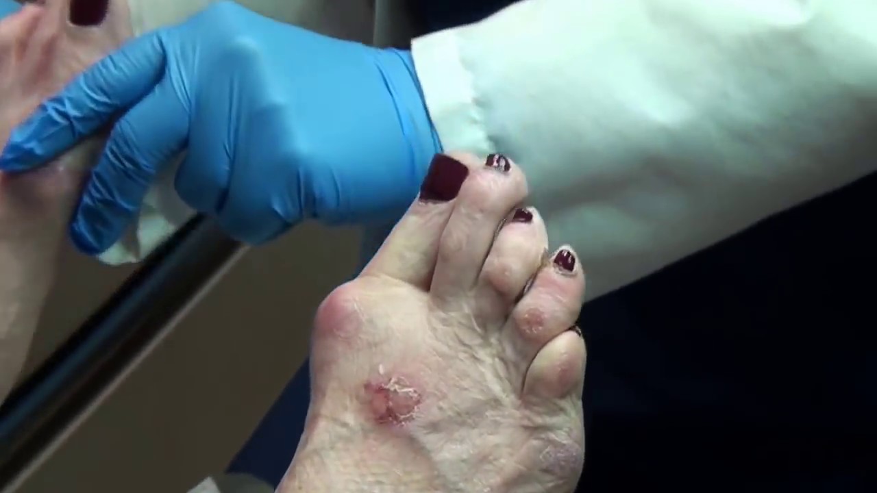Trimming Painful Corns on Toes YouTube