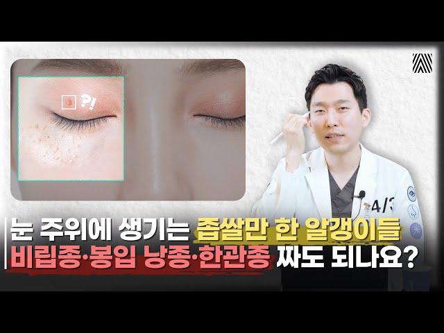 눈 주위에 생긴 좁쌀만 한 알갱이들.. 비립종·봉입 낭종·한관종 관리 방법! _[4월31일 성형외과]