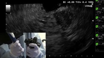 EUS FNA of Pancreatic Uncinate Mass