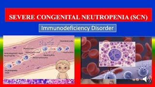SEVERE CONGENITAL NEUTROPENIA (SCN) - types, causes, pathophysiology, symptoms, diagnoses, medicine screenshot 4