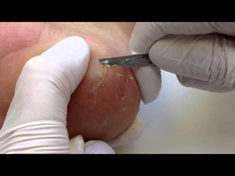 Video: Hoe zich te ontdoen van hyperpigmentatie: 10 stappen (met afbeeldingen)