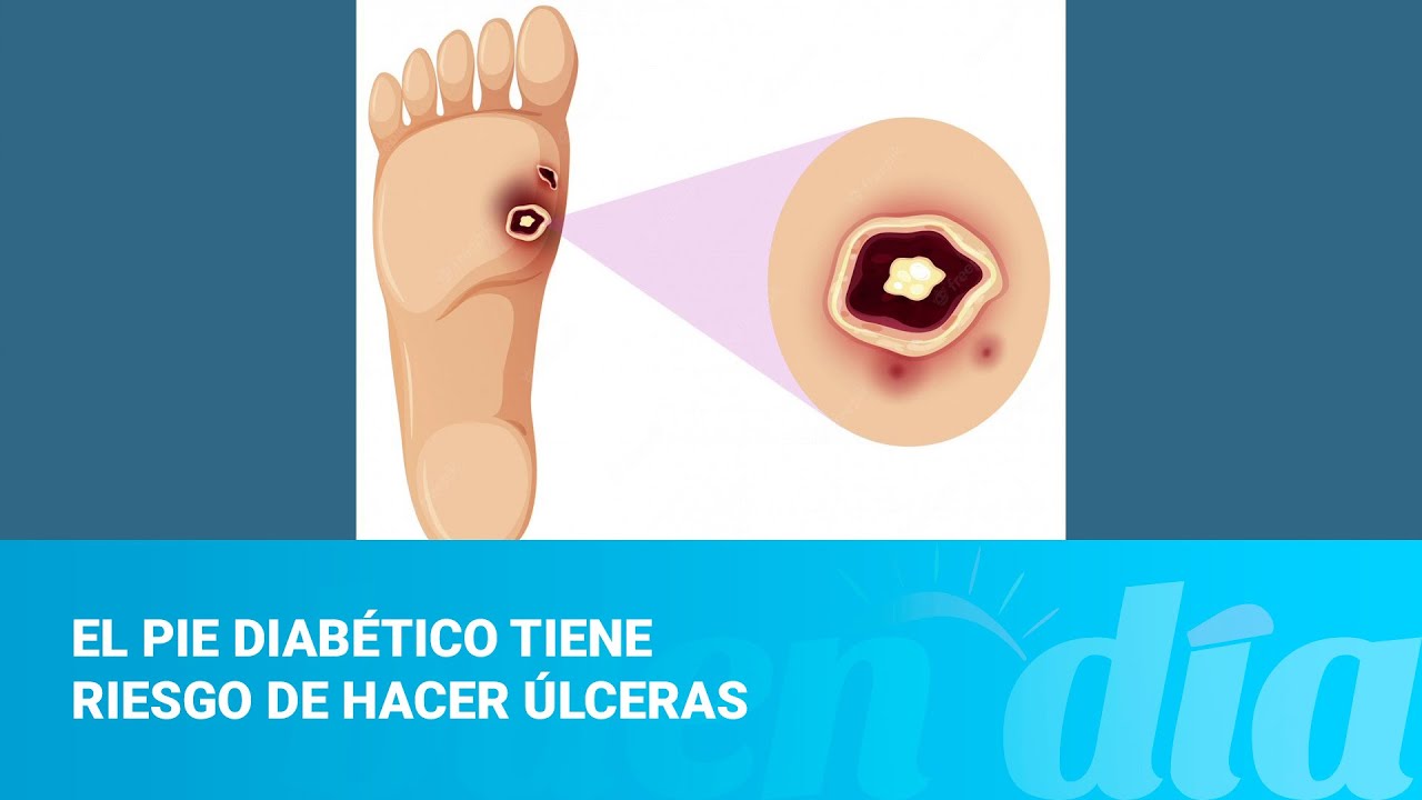 El pie diabético tiene riesgo de hacer úlcerasv YouTube
