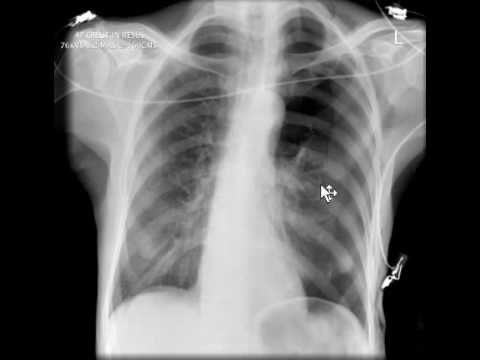 chest x ray pneumothorax pneumothorax x ray