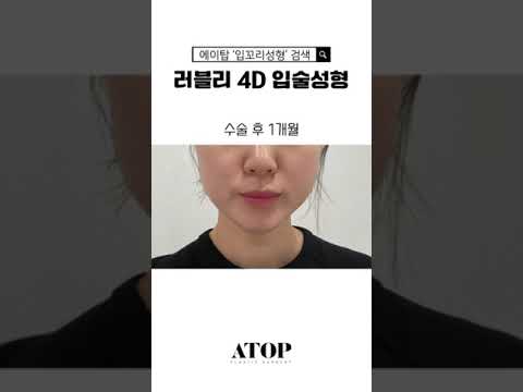 [艾塔整形外科] 嘴角整形，幸好做了！ #江南站整形外科 #嘴角手術前後 #嘴角手術 #嘴角手術前後 #擅長嘴角手術醫院 #嘴角手術後記