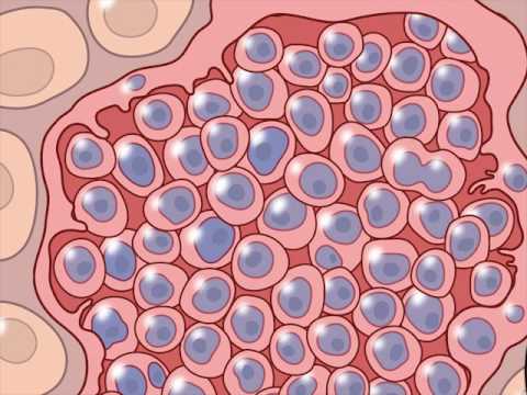Video: Vilken parasit orsakar onchocerciasis?