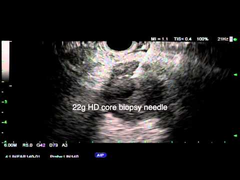 Video 8 EUS FNB Lymph Node