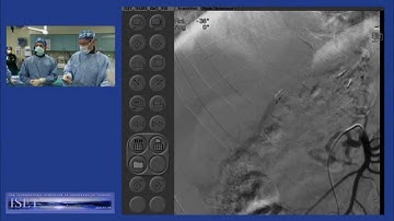 Chemoembolization of Right Hepatic Lobe