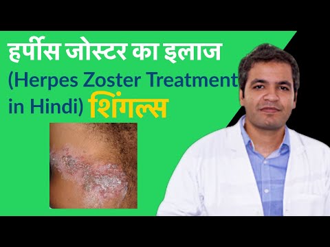 हर्पीस जोस्टर (herpes zoster) या  shingles क्या है? इसके कारण, लक्षण और इलाज | Herpes Zoster ka Ilaj