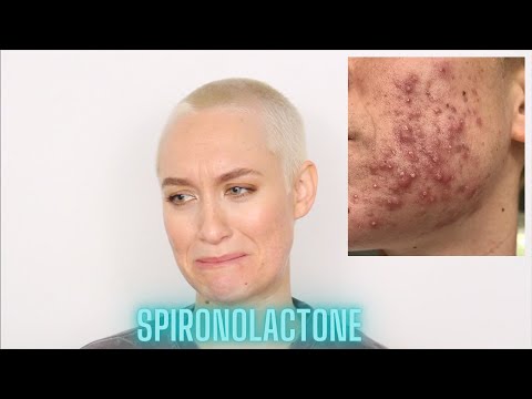 My Spironolactone & Differin Experience | How I Cleared My Acne In 3 Months | Kiki G.