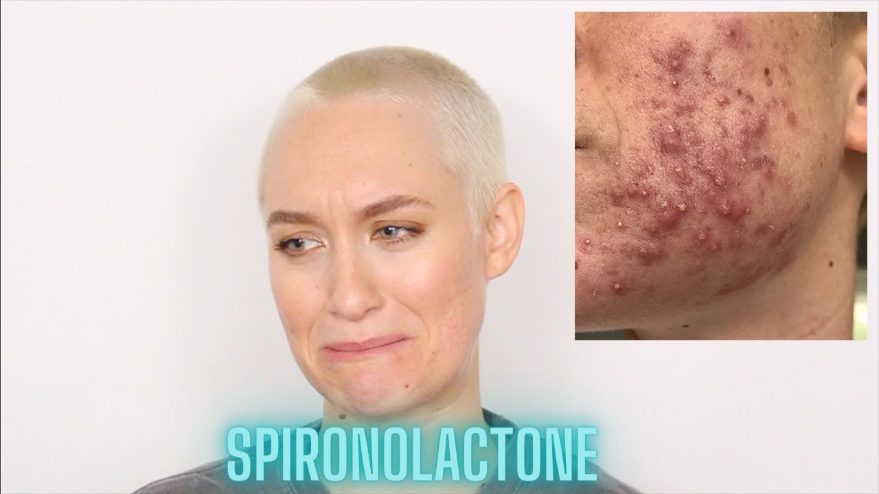 My Spironolactone & Differin Experience How I Cleared My Acne In 3