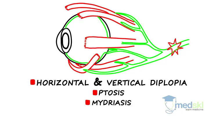 Ophthalmology  Diplopia: By Martin ten Hove M.D.