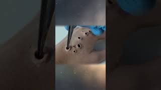 Maggot removal from wound