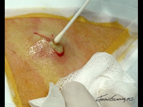 Cozmo Back Cyst Pus & Treat With Super Gumby!