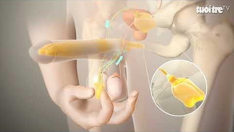 Điều trị miễn phí cho 50 bệnh nhân rối loạn cương bằng kỹ thuật mới