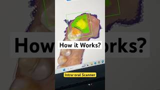 How Intra oral Scanner Works?(HIGH TECH APPROACH) #technology