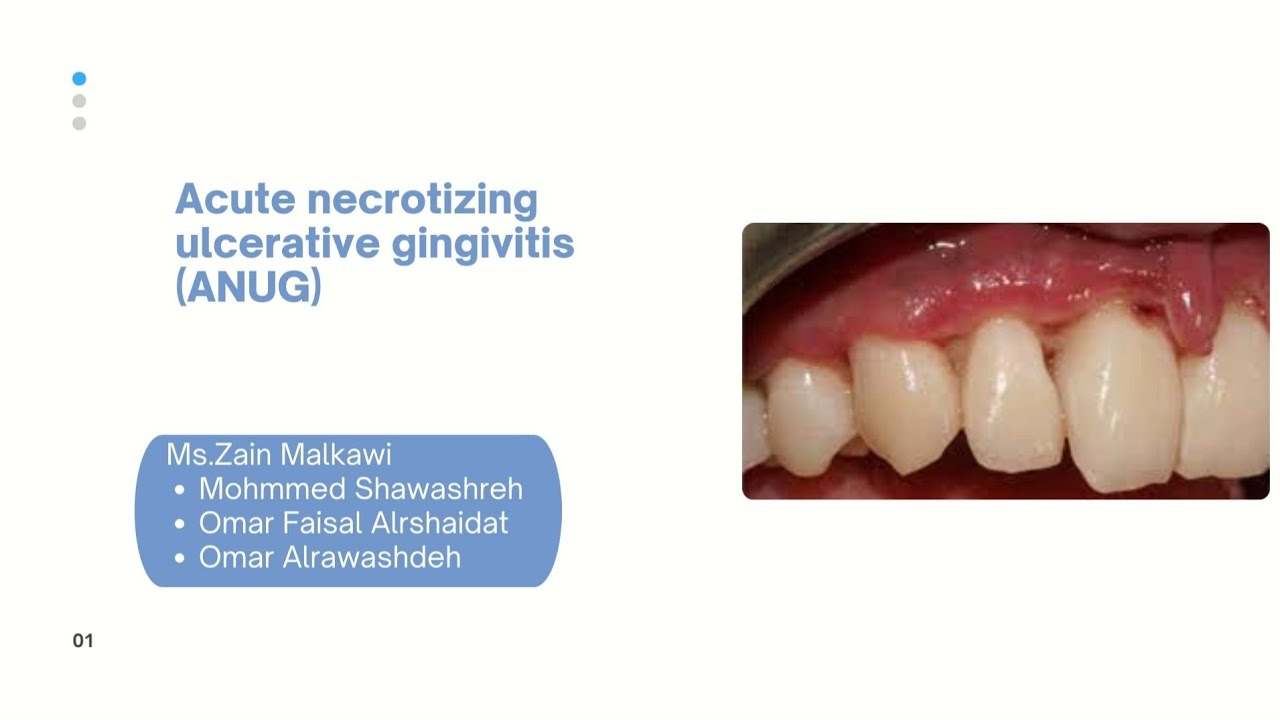 Acute necrotizing ulcerative gingivitis (ANUG) YouTube