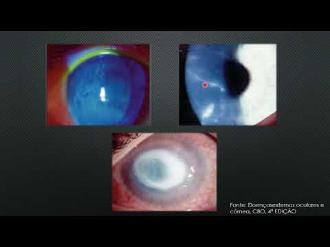 Vídeo: Ceratite Acanthamebiana - Sintomas, Tratamento, Formas, Estágios, Diagnóstico