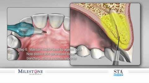 The Wand- znieczulenie podniebienne P-ASA