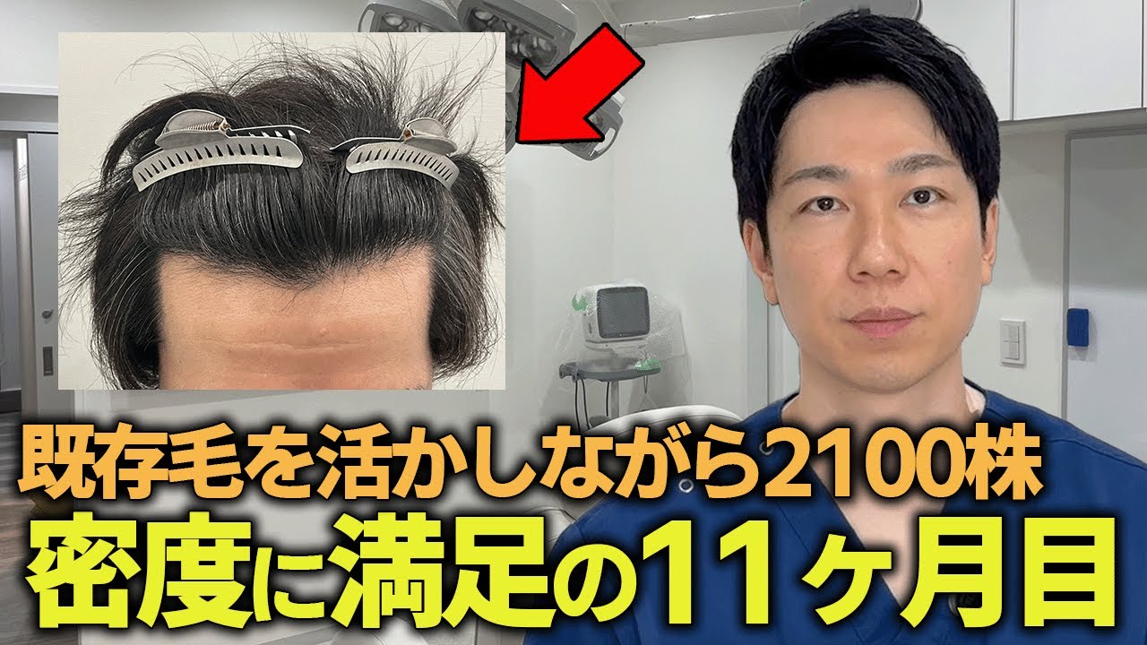 ドクターが「本当に非常に良く」と振り返る｜2100株の植毛手術を