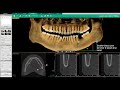 Vatech ez3di  3d pan tab 02  tracer un nerf mandibulaire