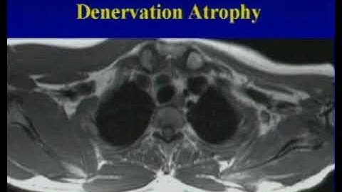 Imaging of the Brachial Plexus