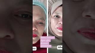 Dhskin f&b Treatment Dhskin f&b Treatment