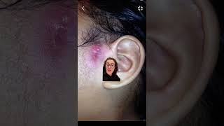 ??:  Infected Ear Pit- Heres what to do about it  earpit infection entdoctor embryology