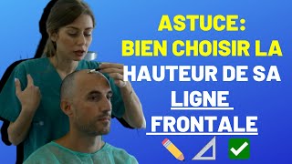 GREFFE de CHEVEUX : BIEN CHOISIR LE DESSIN DE LA LIGNE FRONTALE POUR UNE GREFFE REUSSIE!! 