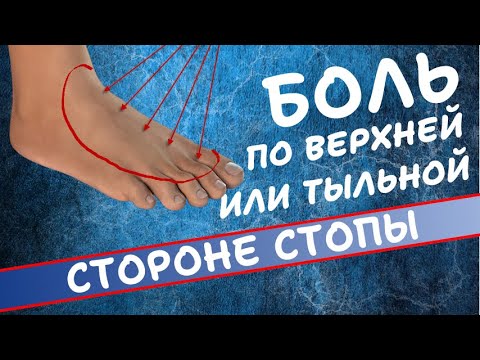 БОЛЬ ПО ВЕРХНЕЙ ИЛИ ТЫЛЬНОЙ ЧАСТИ СТОПЫ  |  СУСТАВЫ ИЛИ ПОЗВОНОЧНИК?