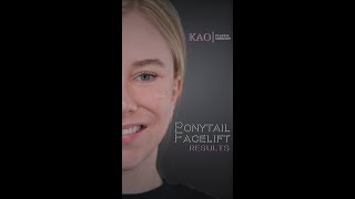 Ponytail Facelift Results