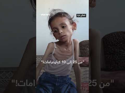 معاناة الطفلة مريم دواس من سوء التغذية في اليمن