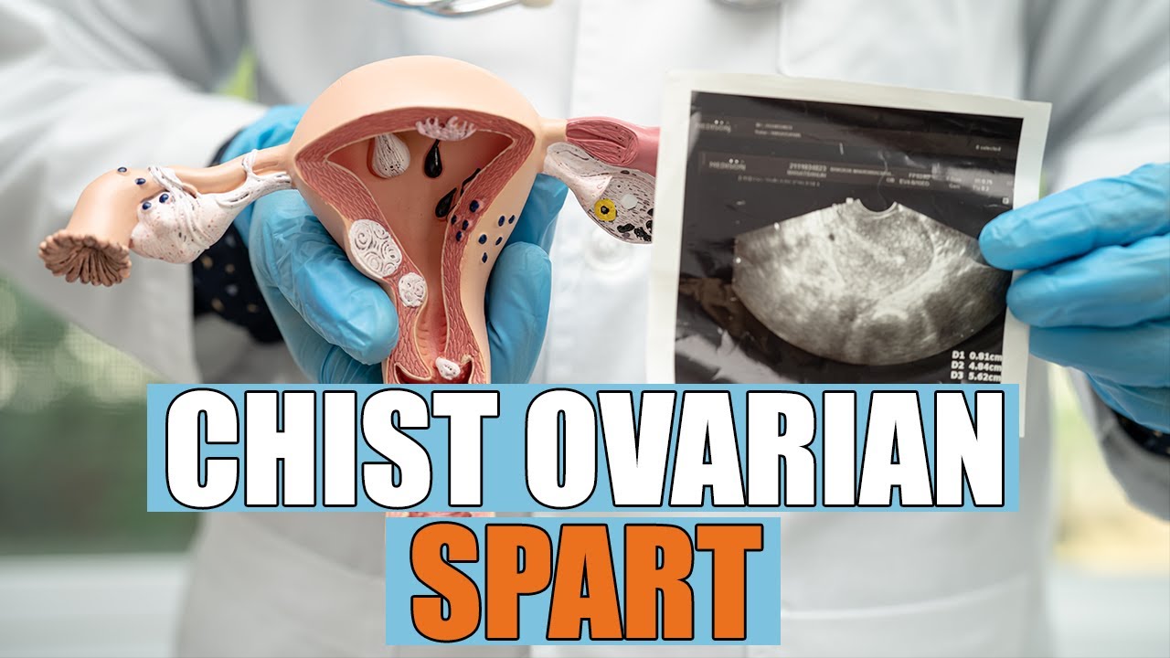 Operatia De Chist Ovarian www.youtube.com