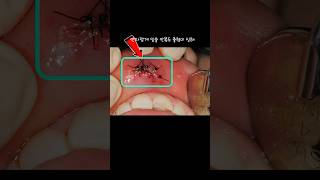 부러진 치아 치료  #사람사랑치과 with CLOVA Dubbing