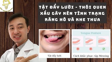 Tật đẩy lưỡi - Thói quen xấu gây nên tình trạng răng hô và khe thưa