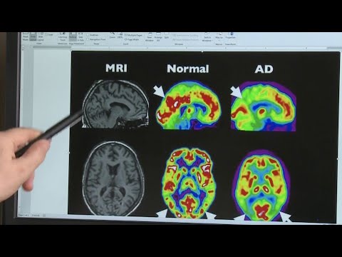 Video: Cine este cel mai probabil să sufere de Alzheimer?