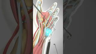 Ganglion Cyst Removal