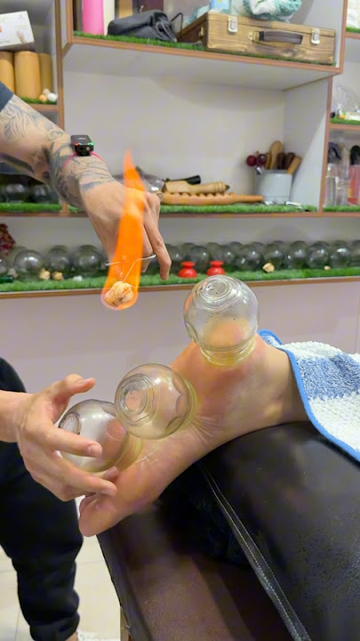 Her legs burned 😱#asmr #shorts #explore #massage #viral #cupping #youtubeshorts #fire