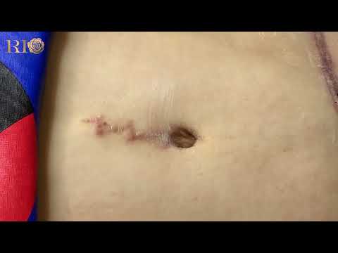 Video CA XĂM MÀU DA CHE SẸO LỒI QUÁ HOÀN HẢO l THẨM MỸ RIO - youtube