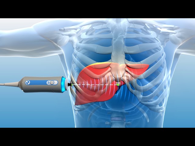 Liver Fibroscan Chart