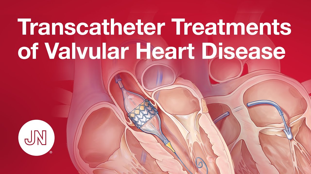 Transcatheter Treatments Of Valvular Heart Disease Youtube