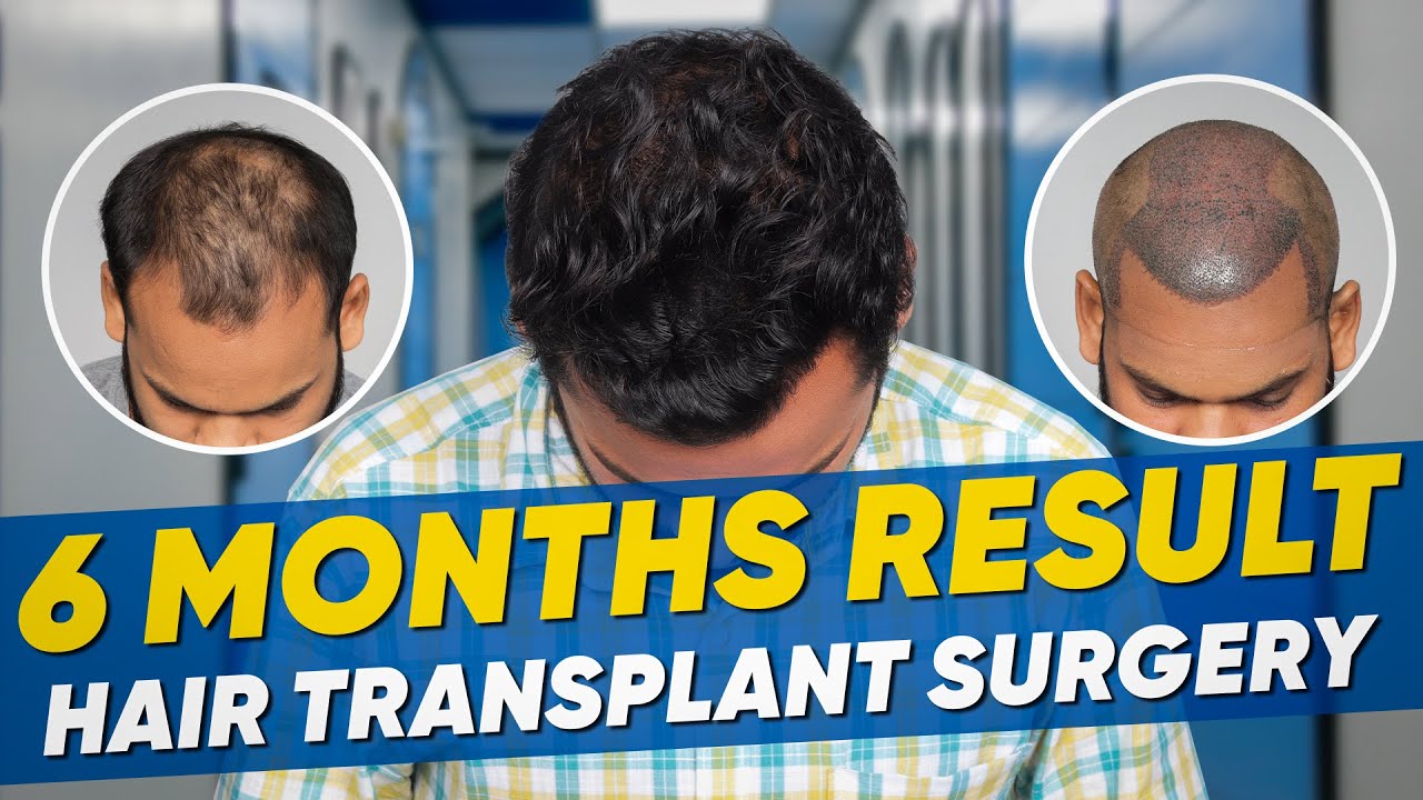 Hair Transplant in Trivandrum Best Results & Cost of Hair Transplant