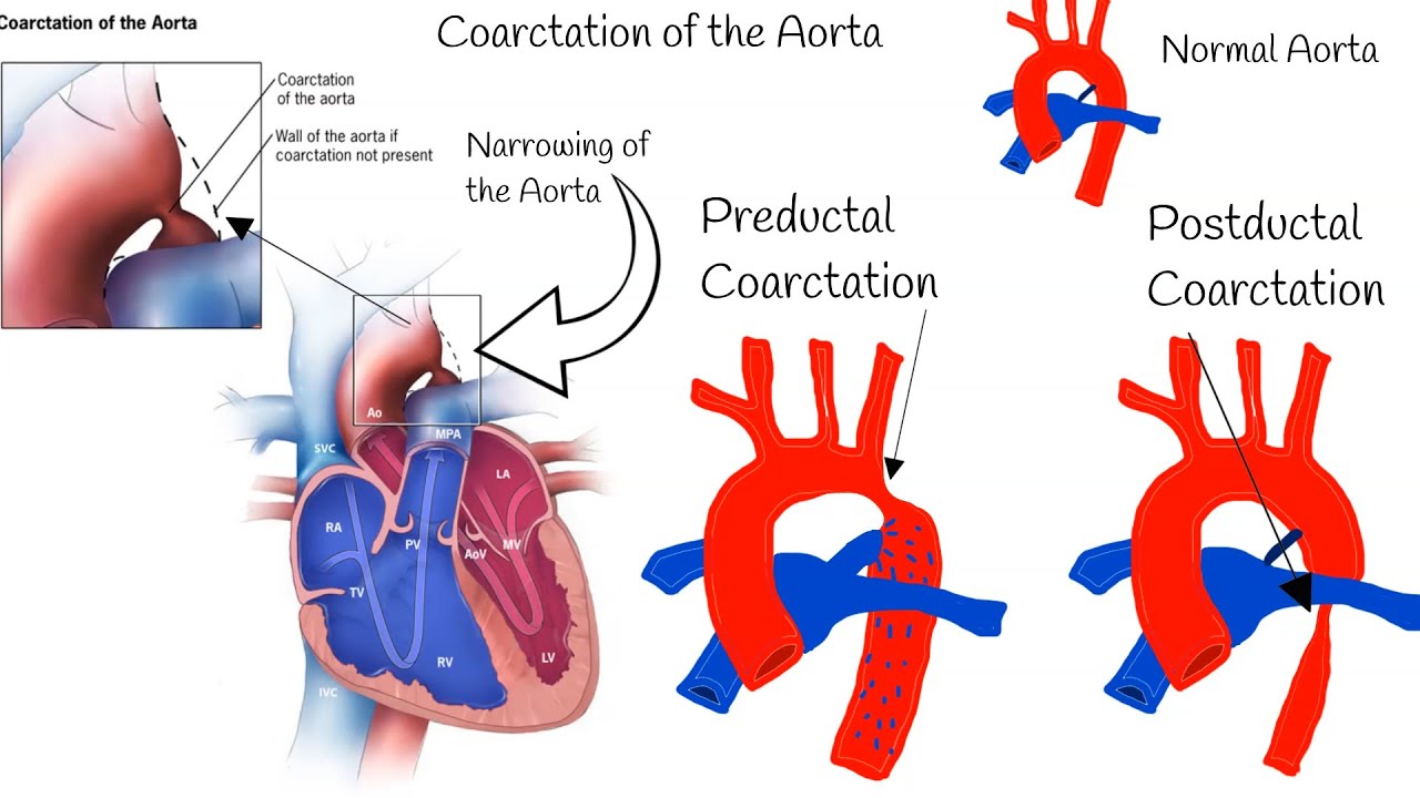 Coarctation Of The Aorta - Symptoms, Diagnosis And Treatment