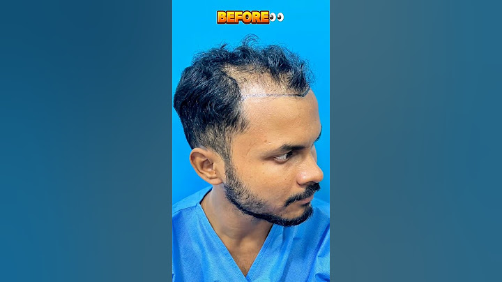 HAIR TRANSPLANT RESULTS That Will SHOCK You After 4 MONTHS! #shorts