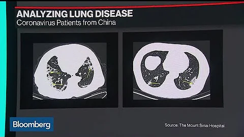 How Lung Scans are Helping Doctors Learn About Coronavirus