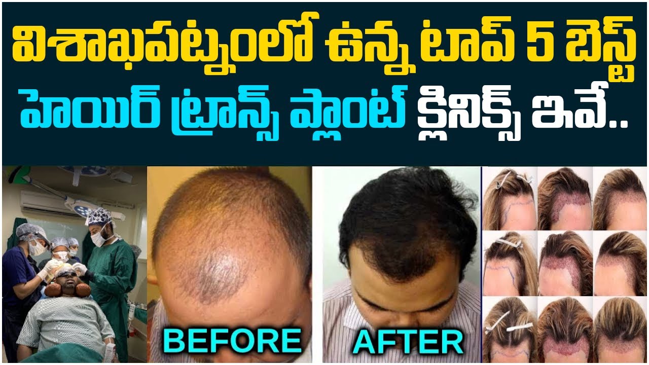 Best hair transplant in Vizag Visakhapatnam Andhra Pradesh