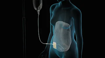 ¿Cuál es la función de un riñón artificial?