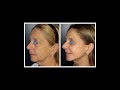 Avant  aprs  lifting facial  rsultats dopration sur plusieurs patients